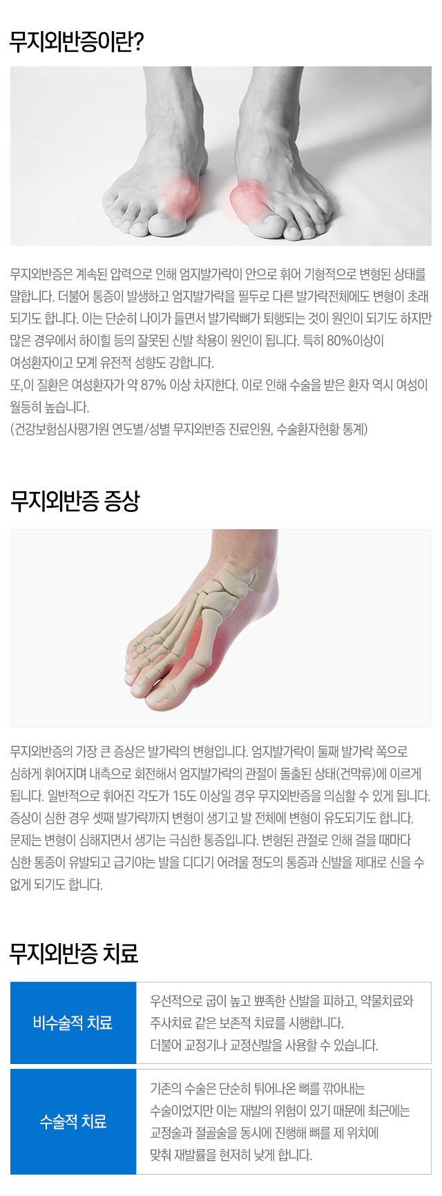 무지외반증