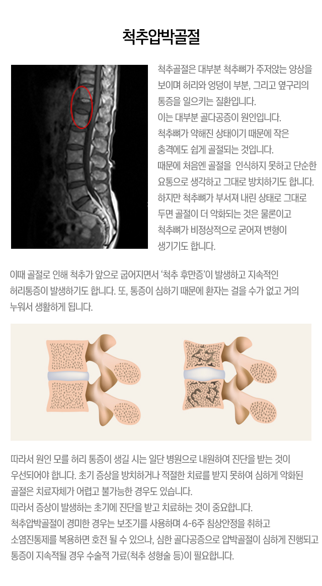 척추압박골절