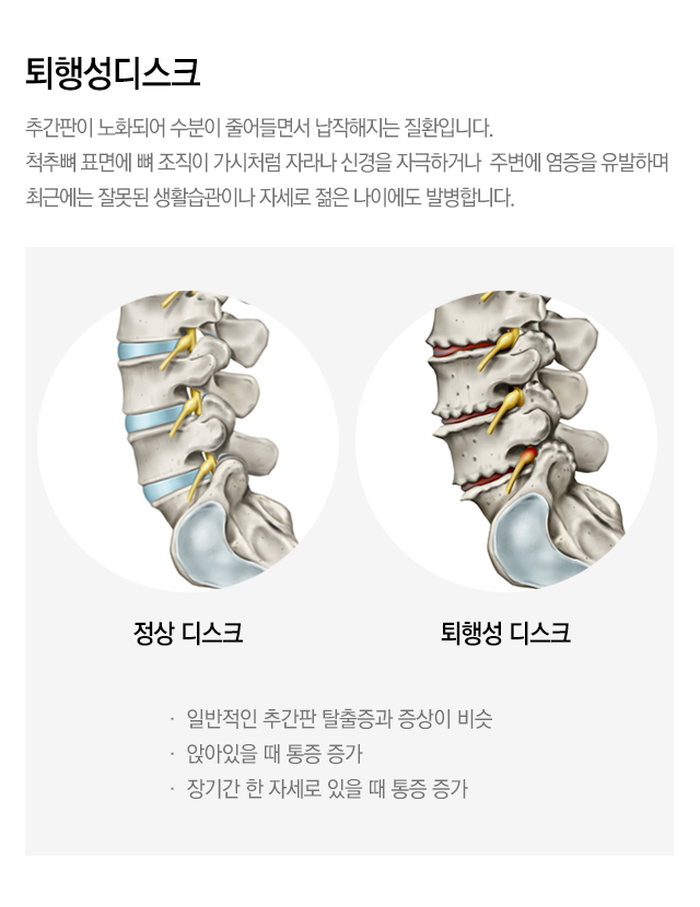 내시경 치료 가능한 척추질환